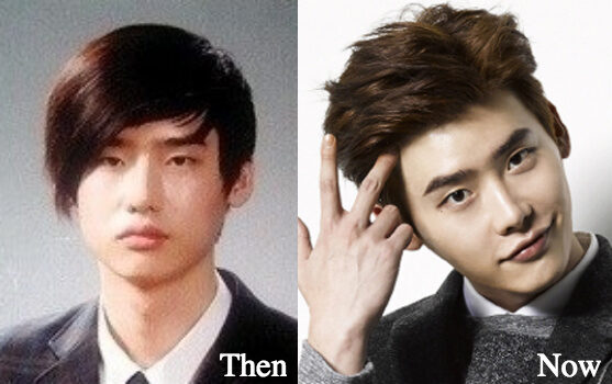 lee-jong-suk-plastic-surgery-before-and-after-photos-7467530