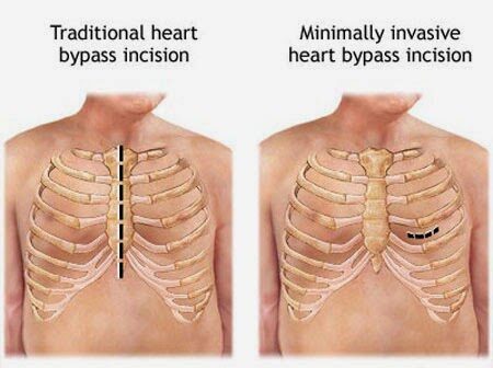 minimally_invasive_cardiac_surgery-8415923
