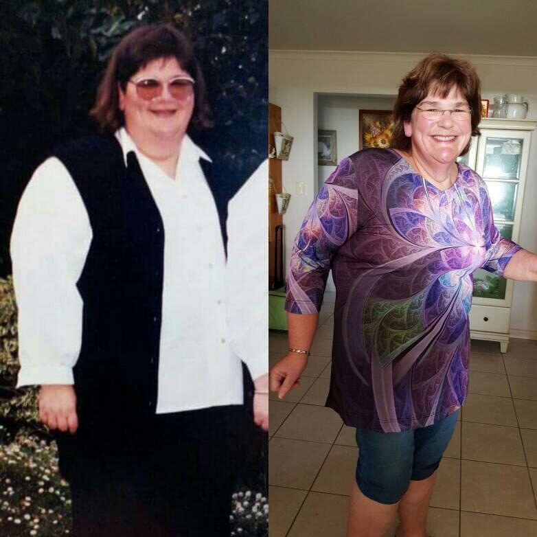 weight-loss-surgery-transformation-5060317
