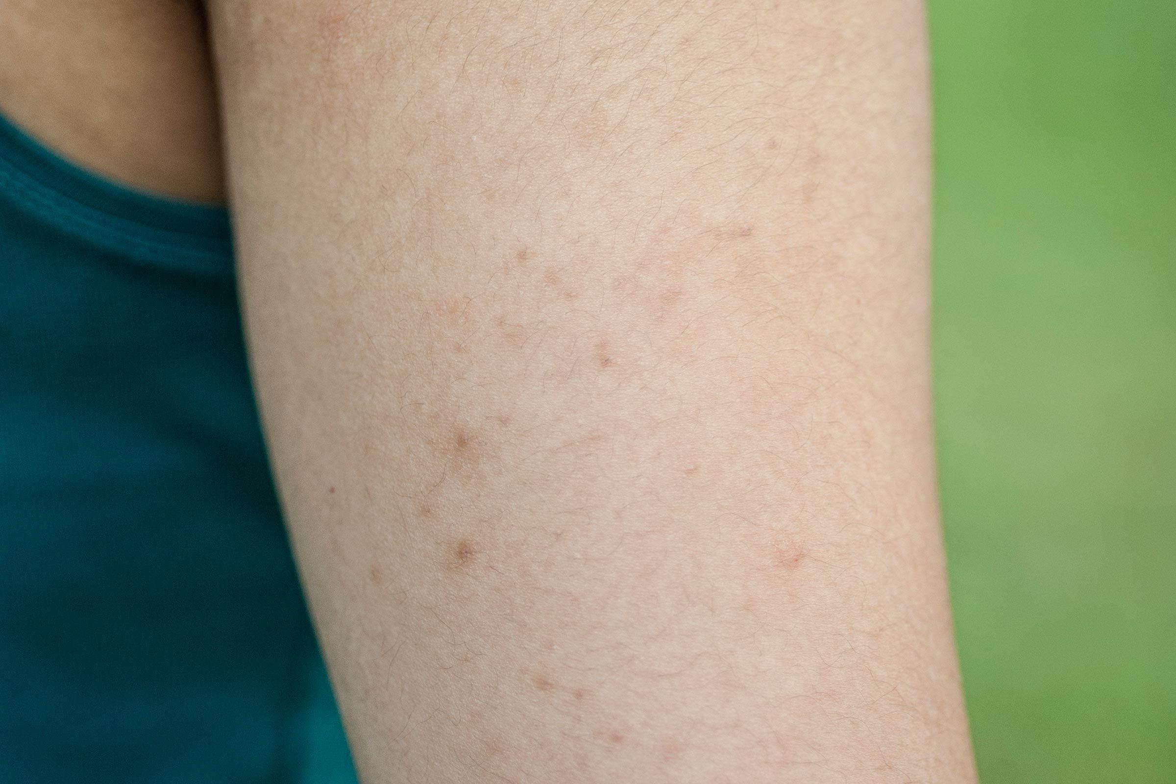 01-understanding-how-to-get-rid-chicken-skin-arms-515720503-russaquarius-4804718