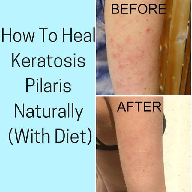 03cd4-how-i-healed-my-keratosis-pilaris-html-8575028