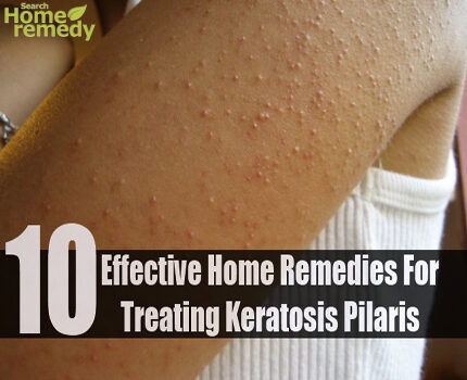 10-effective-home-remedies-for-treating-keratosis-pilaris-8090432