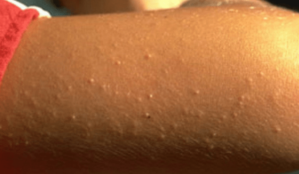 2-19-18-keratosis-pilaris-600-x-350-3230356