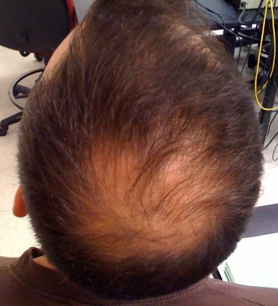alopecia-5143008