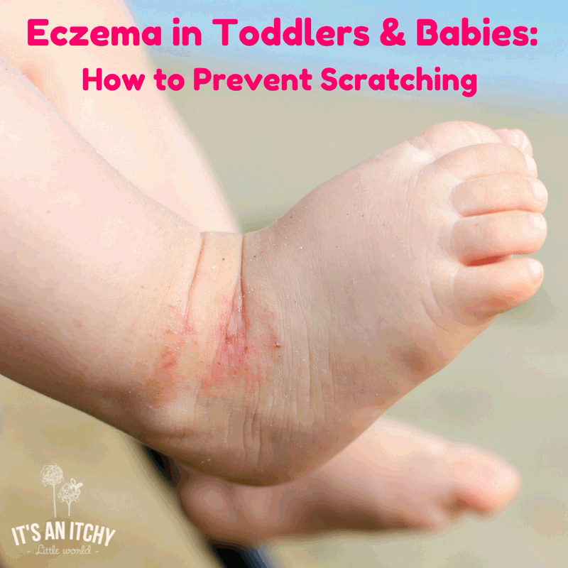 eczema-in-toddlers-babies-how-to-prevent-scratching-6445048