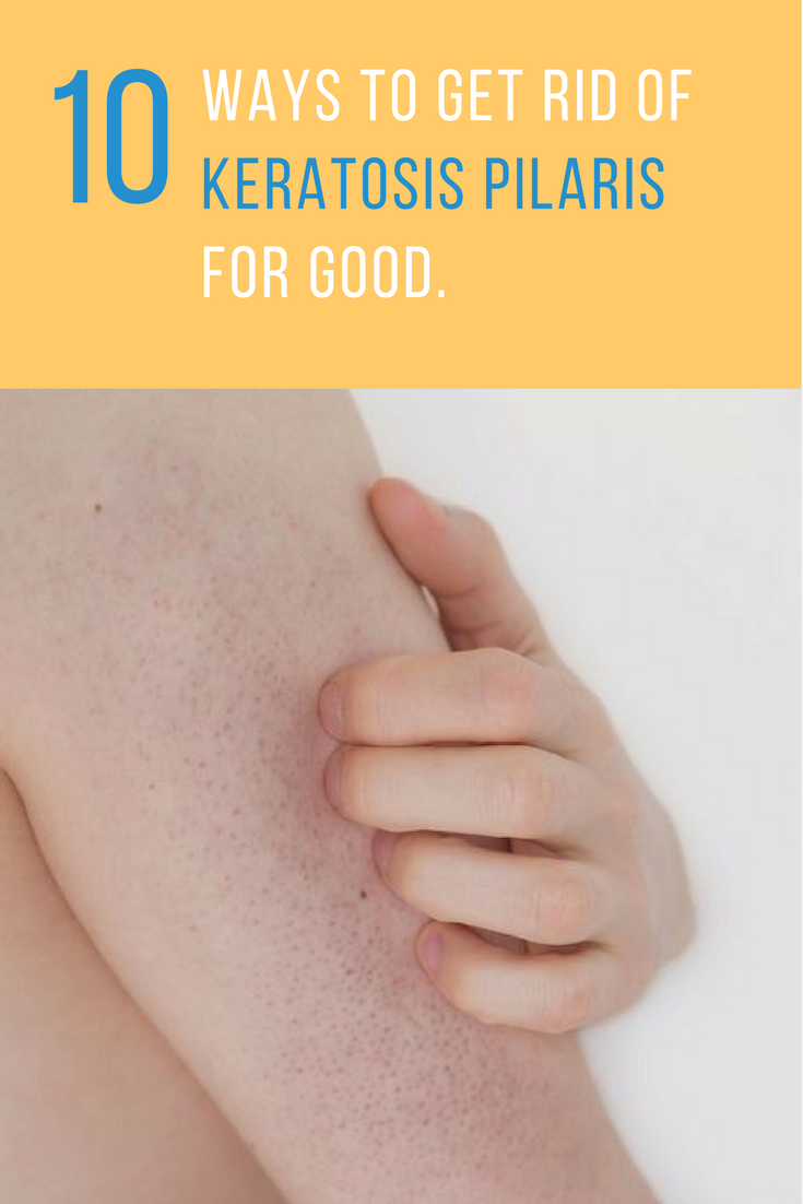 get-rid-of-keratosis-pilaris-5247169