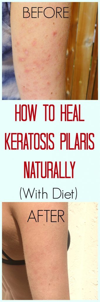 how-to-heal-kp-naturally-341x1024-6334102
