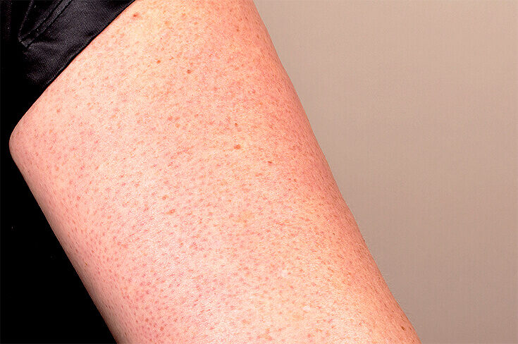 keratosis-pilaris-1-8520366