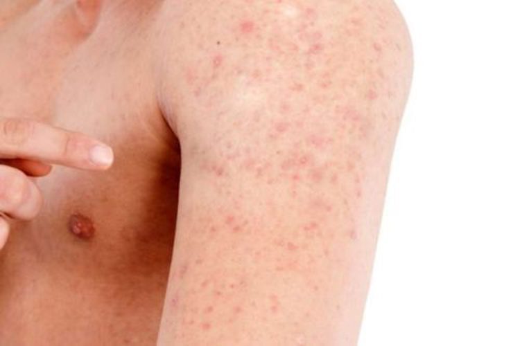 keratosis-pilaris-6653088