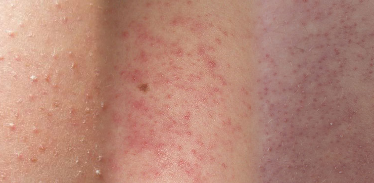keratosis-pilaris-chicken-skin-e1400766539793-5926214