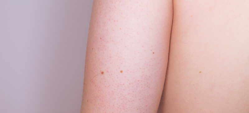 keratosis-pilaris_header-9924001