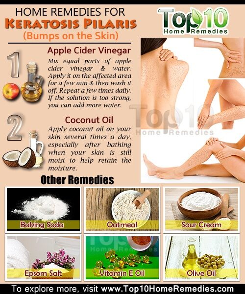 keratosis-pilaris-opt-6316010