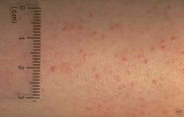 keratosis-pilaris_landing-3982664