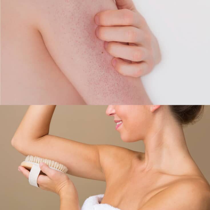 keratosispilaris_background-4959927