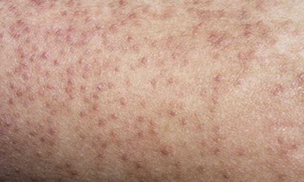 keratosis_pilaris-1357618