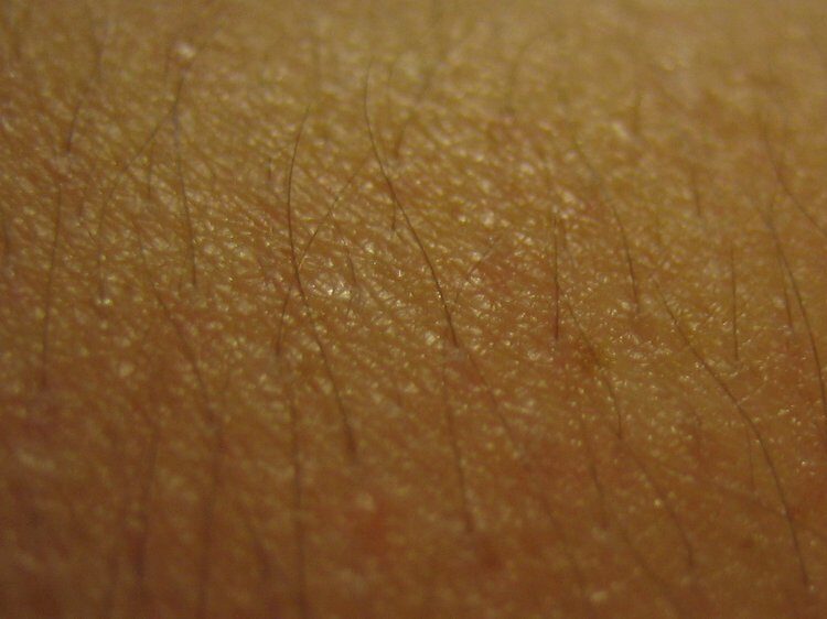 keratosis_pilaris-16x9-width-750-8115302