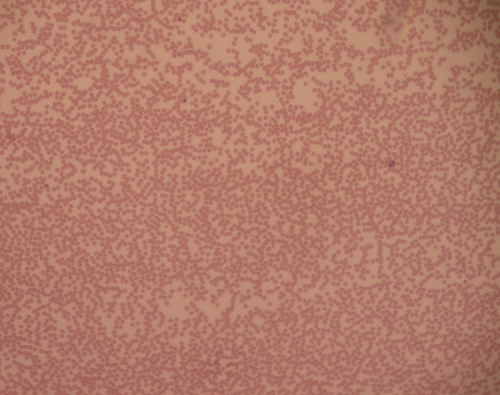 neutropenia-3173967