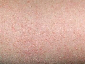 pmd_keratosis_pilaris_en-4919458