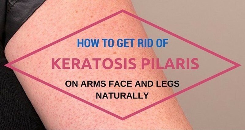 how-to-get-rid-of-keratosis-pilaris-9901357