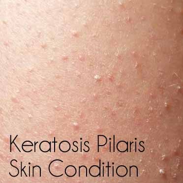 keratosis-9553108
