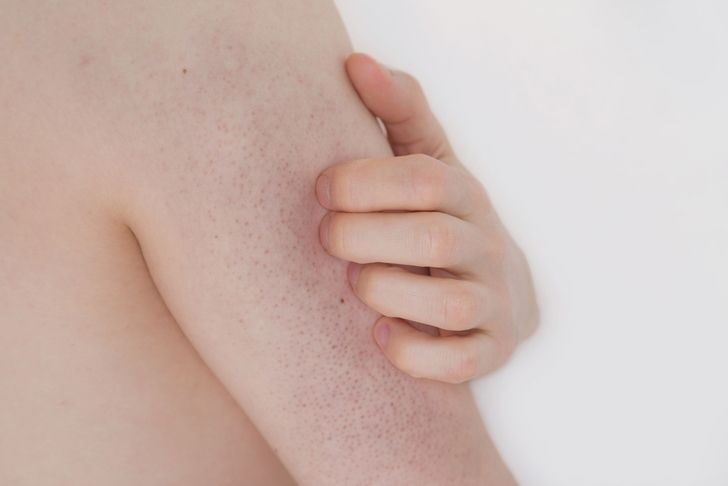 keratosis-pilaris-5-8208972