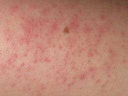 keratosis-pilaris-7157274