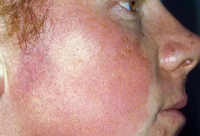 keratosis-pilaris-atrophicans-4362327
