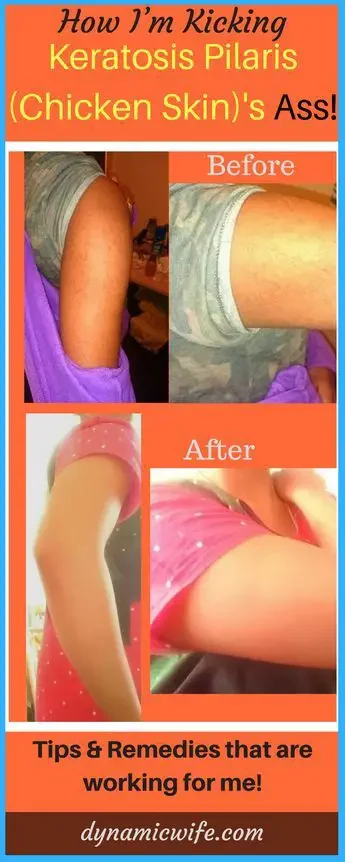 keratosis-pilaris-home-remedies-and-treatment-3285778
