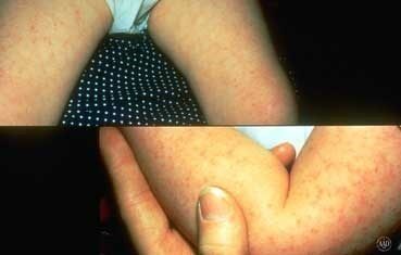 keratosis-pilaris_causes-7462462