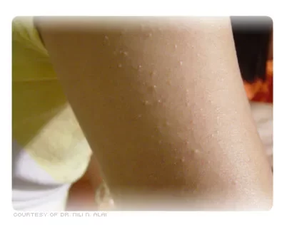 keratosis_pilaris_1-5697005