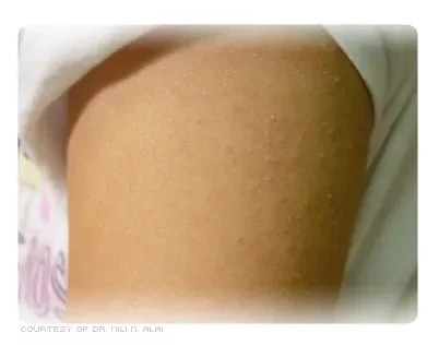 keratosis_pilaris_2-9794119