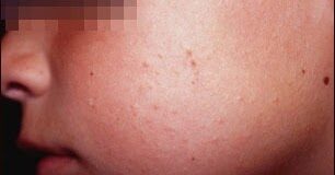 keratosispilaris-1812836