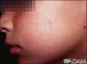 keratosispilaris-9309566