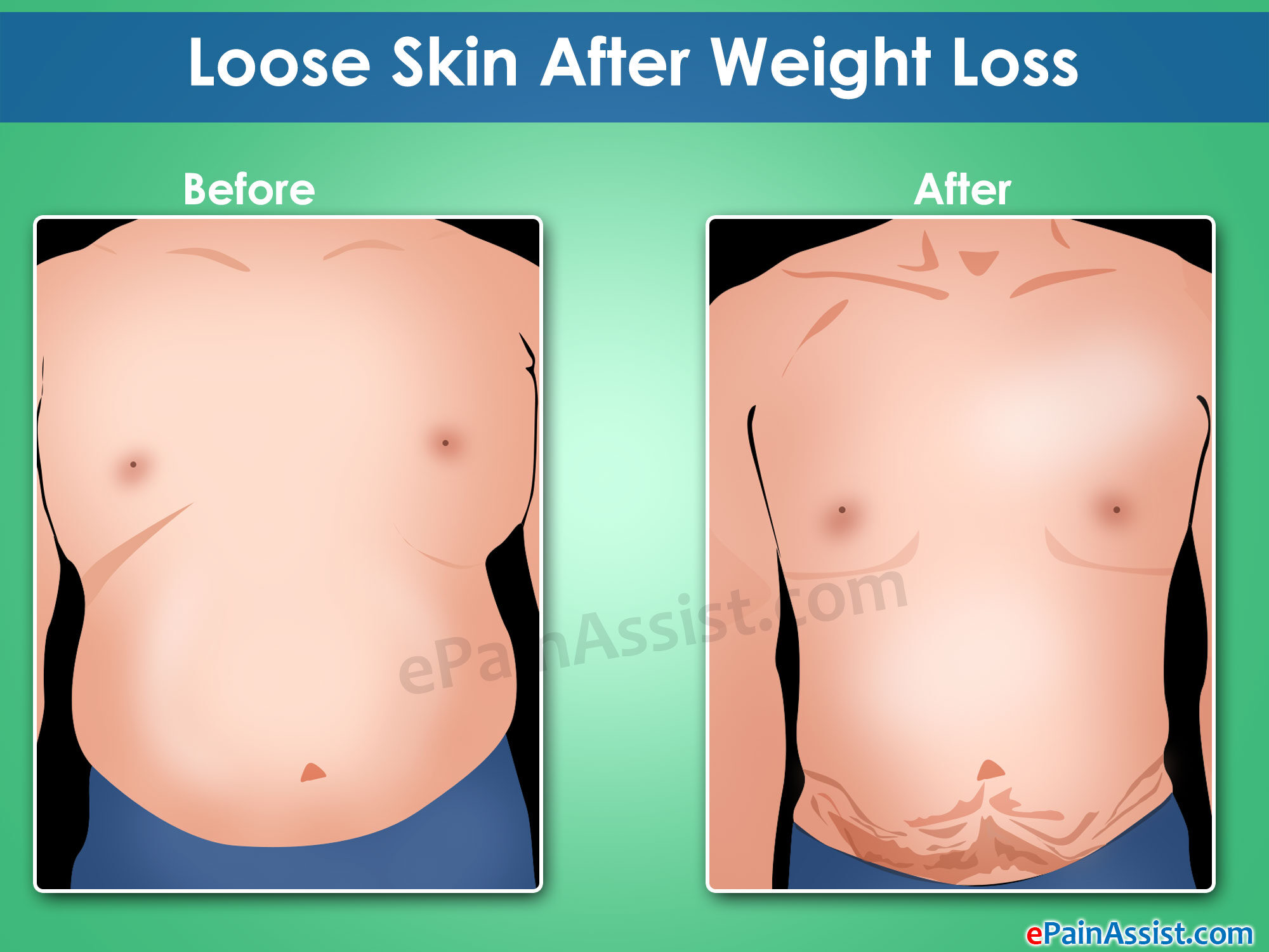 loose-skin-after-weight-loss-6349436