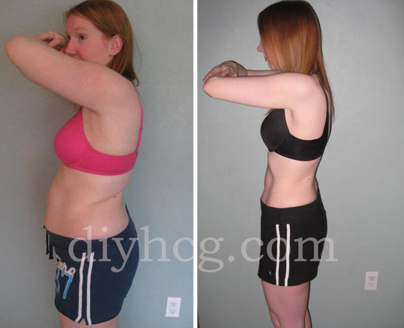 rebecca-hcg-before-and-after-photos-side-1998438